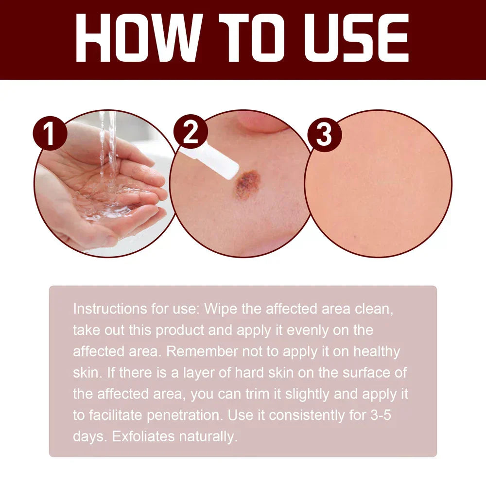 Candice™ - Formel Zur Entfernung Dunkler Flecken  (1+1 GRATIS!)