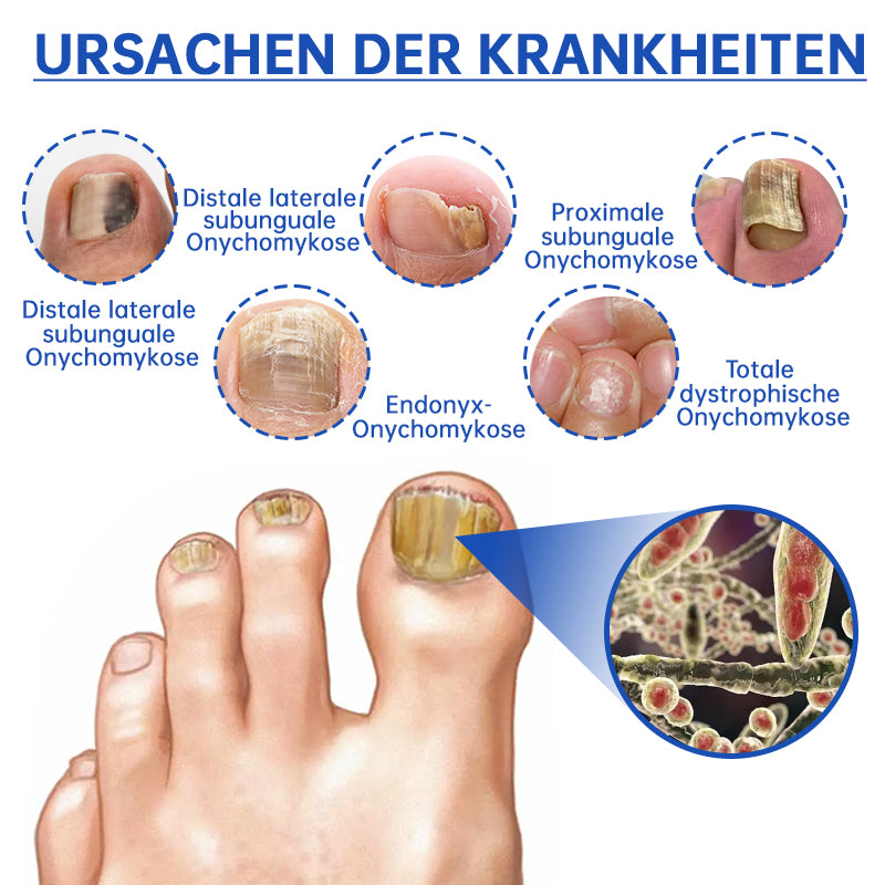 NailCure™ - Nagelpilz-Laserbehandlung Lösung (50% RABATT)