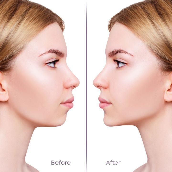 Unsichtbares Face Lifter Tape (40 Stück)